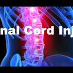 Causes And Prevention Of Spinal Cord Injuries